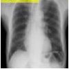 X-ray chest
