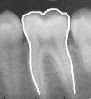 X-ray tooth