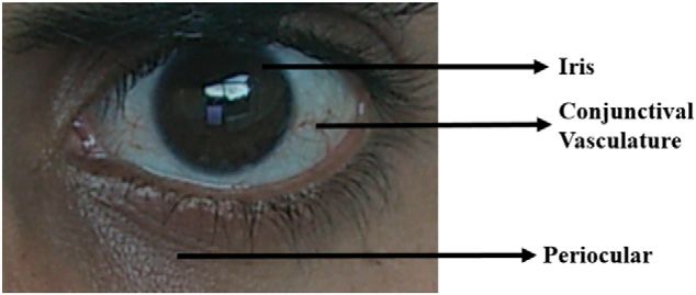 eye, iris, conjunctival, periocular