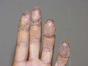 fingerprints altered using skin taken from foot